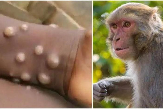 WHO sẽ cân nhắc ban bố tình trạng y tế khẩn cấp đối với bệnh đậu mùa khỉ